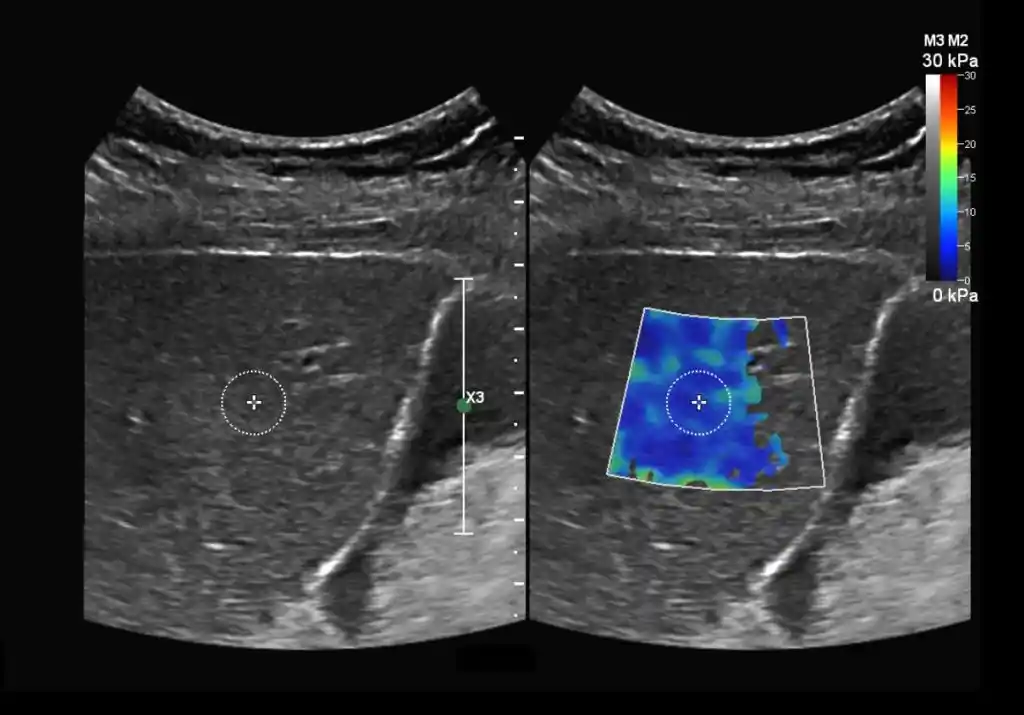 Élastographie abdominale réalisée avec un échographe